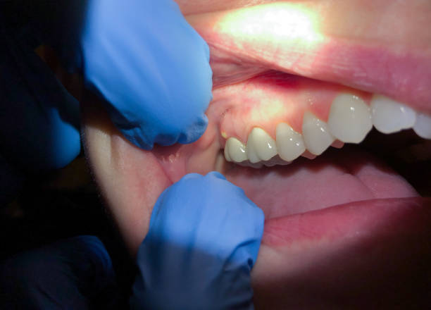 Best Broken or Chipped Tooth Repair in Egan, LA