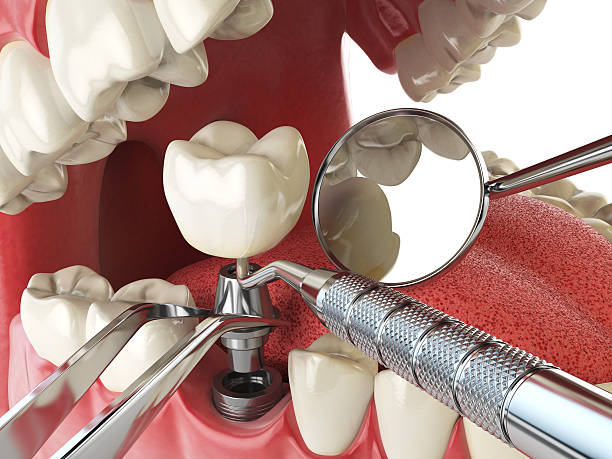 Best Lost Filling or Crown Replacement in Egan, LA